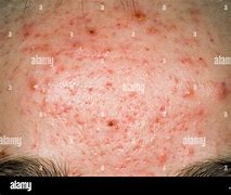 Image result for Pustules On Forehead