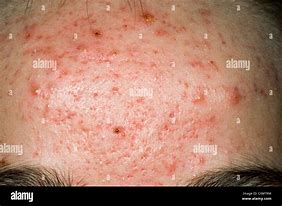 Image result for Skin Rash with Pustules