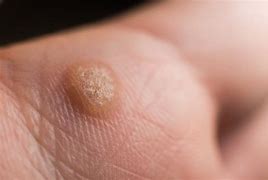 Image result for Flat Skin Warts