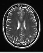 Image result for Abnormal Brain MRI without Contrast