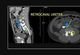 Image result for Lest Sided Retrocaval Ureter