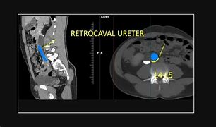 Image result for Retrocaval Ureter MRI