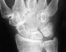 Image result for Triscaphe Joint Space Narrowing