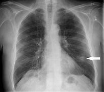 Image result for Pulmonary Nodule X-ray