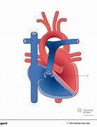 Image result for Right Ventricular Outflow Tract