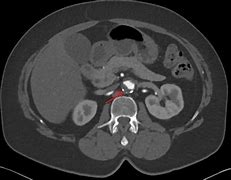 Image result for Post-Mortem Thrombus