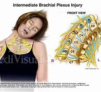 Image result for Brachial Plexus Fall Injury