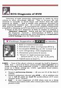 Image result for RVH ECG