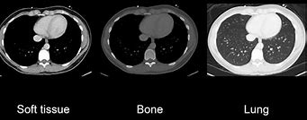 Image result for Lung Window CT