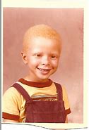 Image result for Albino Child