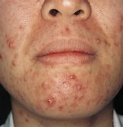 Image result for Viral Pustules