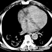 Image result for Multiple Lung Nodules