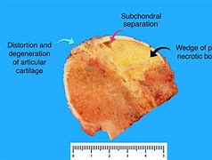 Image result for Avascular Necrosis Pathology