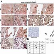 Image result for DDR and Bone Metastasis