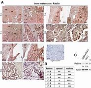 Image result for DDR and Bone Metastasis