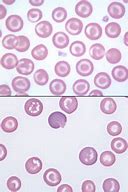 Image result for Target Cells RBC