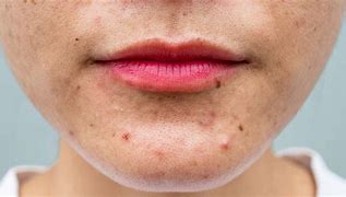 Image result for Pimple Breakout