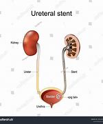 Image result for Abdominal Ureter