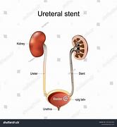 Image result for Long Tunnel Ureter