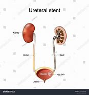 Image result for J-shaped Ureter