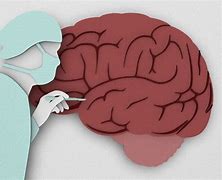 Image result for Dementia بیماری