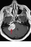 Image result for Vestibular Schwannoma Gross Pathology