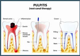 Image result for Root Canal Darkening