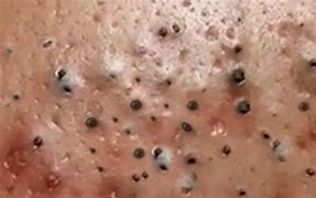 Image result for Big Pimple in the Face