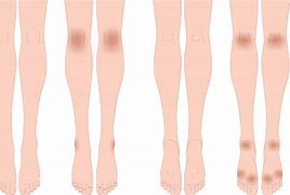 Image result for Skin Darkening Legs