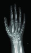 Image result for Bone Age Hand X-ray