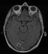 Image result for Seizure On MRI