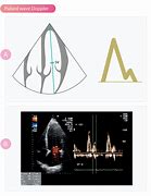 Image result for Continuous Wave Doppler Ultrasound