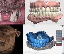 Image result for Printed Dentures