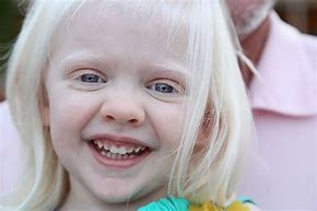 Image result for Albino Child