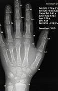 Image result for Bone Age Hand X-ray