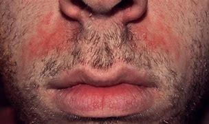 Image result for Candida Face