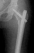 Image result for Orif Hip