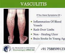 Image result for Vasculitis Leg Ulcers