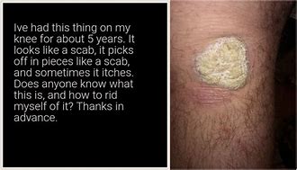 Image result for Knee Scab