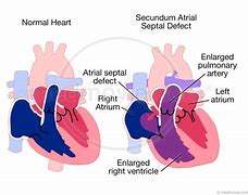 Image result for Septum Secundum