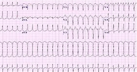 Image result for Atrioventricular Reciprocating Tachycardia