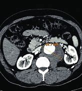 Image result for 3D Reconstruction Angio CT