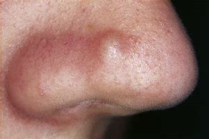 Image result for Papule Pimple