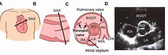 Image result for Right Parasternal View Echo