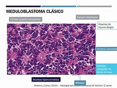 Image result for Medulloblastoma Location Diagram