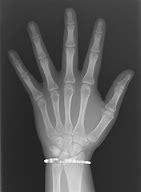 Image result for Bone Age Hand X-ray