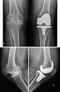 Image result for Left Knee Arthroplasty