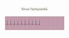 Animated graph showing the sinus Tachycardia rhythm. electrocardiograph monitor graph that shows sinus Tachycardia rhythm.