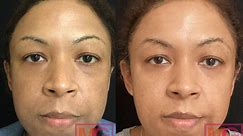 How to do Microneedling for Acne Scars - Dr. Michele Green M.D.