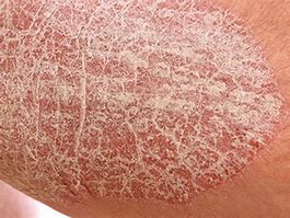 Image result for Thickened Skin On Lower Legs